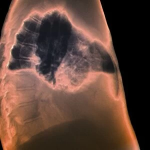 Hydropneumothorax, X-ray C018 / 0586