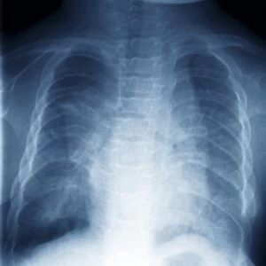 Jeune syndrome, X-ray C018 / 0410