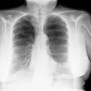 Lung disease, X-ray C017 / 7817