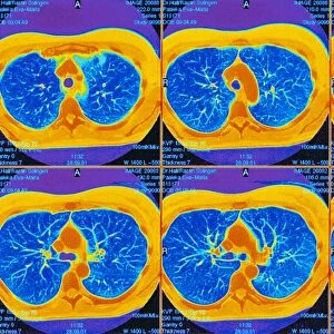 Lungs, CT scans