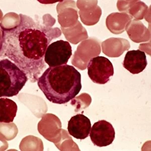 Lymphoplasmacytic lymphoma, micrograph
