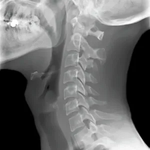 Cuello normal, rayos x Cuello normal, rayos x
