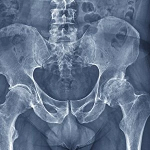 Osteoarthritis of the hip, X-ray F006 / 3744