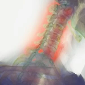 Osteoarthritis of neck, X-ray