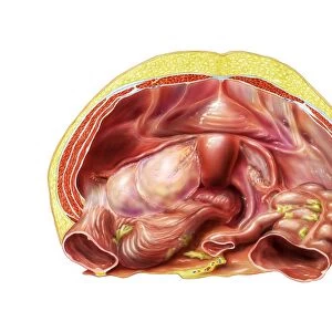Ovarian cyst in abdomen, artwork