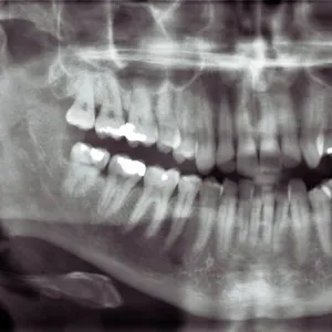 Panoramic dental X-ray