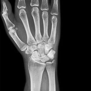 Pinned broken arm, X-ray C017 / 7869