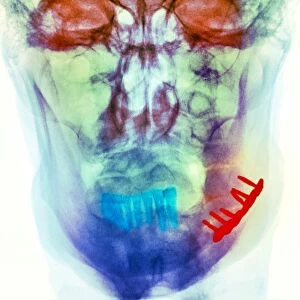 Pinned broken jaw, X-ray
