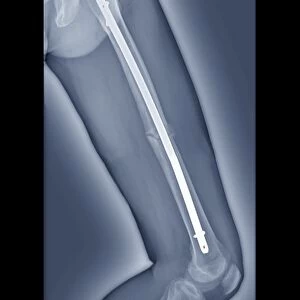 Pinned thigh fracture, X-ray C016 / 6563