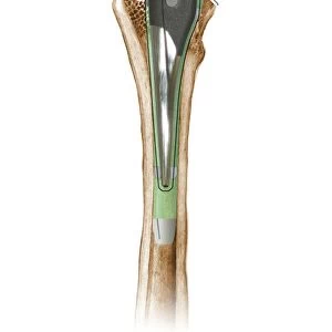 Prosthetic hip joint, diagram C016 / 6775