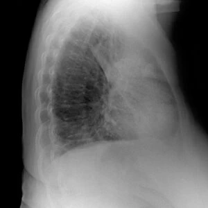 Pulmonary consolidation, X-ray
