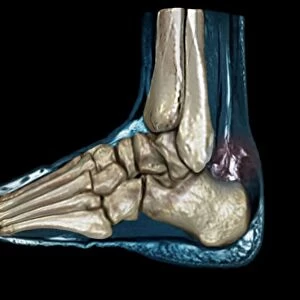Ruptured Achilles tendon, MRI C018 / 0649