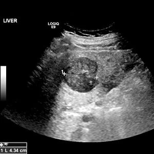 Secondary liver cancer, ultrasound scan C017 / 7764