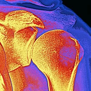 Shoulder joint X-ray
