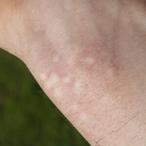Stinging Nettle (Urtica dioica) stung human wrist, Suffolk, England, may