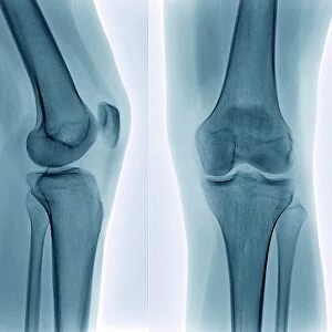 Healthy knee, X-ray