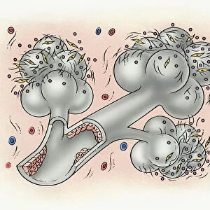 Illustration of bronchus and alveolus covered in inorganic particles, fibroblasts, and growth factor obstructing the internal lining