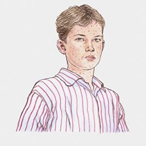 Illustration of teenage boy with chickenpox
