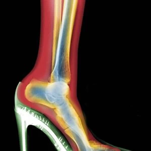 Leg in stiletto shoe MRI style, X-ray