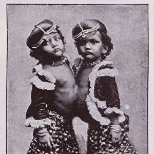 Radica and Doodica, Indian conjoined twins (b / w photo)