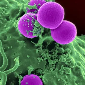 Scanning Electron Micrograph Print of Neutrophil Ingesting MRSA Bacteria Scanning Electron Micrograph Print of Neutrophil Ingesting MRSA Bacteria