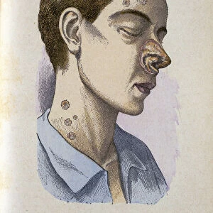 Symptoms of the tertiary phase of syphilis, c19th century