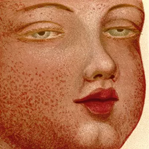 Eruptive Fevers: Scarlatina or Scarlet Fever. From The Household Physician, published c. 1898