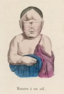 Limited Edition Prints Available Prints: Child with One Eye