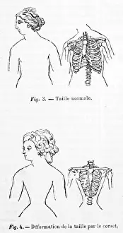 Corset Wearing Effects Print