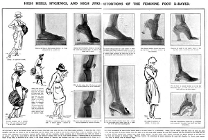 Foot x rays showing damage done by wearing high heels Foot x rays showing damage done by wearing high heels