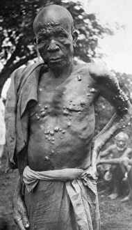 Man with leprosy, Mombasa, Kenya, East Africa Man with leprosy, Mombasa, Kenya, East Africa