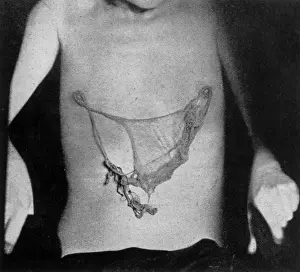 Marthe Beraud Exudes Ectoplasm, Paris, 9 January 1913 Print