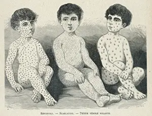 Historical Medical Images Prints: Measles Compared