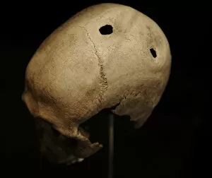 Trepanned skull of a man. 3500-3400 BC. Denmark