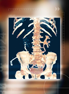 Abdominal bones, 3-D CT scan Abdominal bones, 3-D CT scan