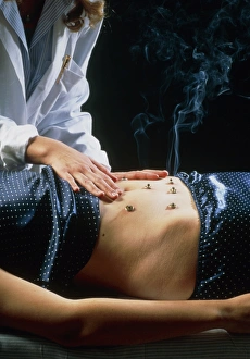 Acupuncturist carries out moxibustion on abdomen Acupuncturist carries out moxibustion on abdomen