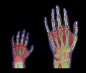 Adult and child hand X-rays Adult and child hand X-rays