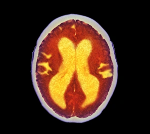 Alzheimers disease brain, coloured CT scan Alzheimers disease brain, coloured CT scan