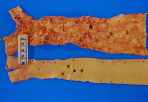 Aorta affected by atherosclerosis & normal one Aorta affected by atherosclerosis & normal one