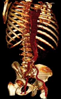 Atherosclerosis Prints: Aortic dissection, 3D CT scan