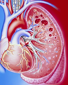 Art of pulmonary tuberculosis with lung cavities Art of pulmonary tuberculosis with lung cavities