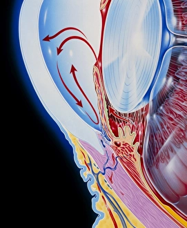 Art of section through human eye showing glaucoma Art of section through human eye showing glaucoma