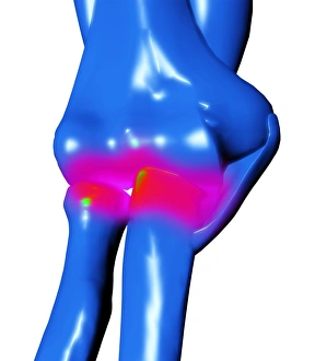 Framed Print : Arthritic Elbow Print Framed Print : Arthritic Elbow Print