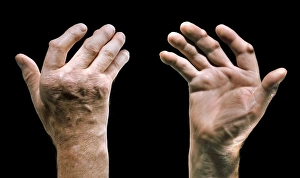 Arthritis Symptoms Prints: Arthritic hands