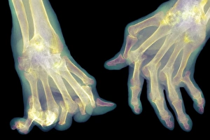 Rheumatoid Arthritis Symptoms Prints: Arthritic hands, X-ray