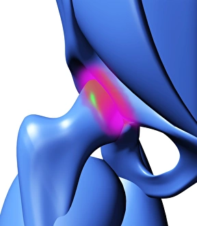 Arthritic hip, computer artwork Arthritic hip, computer artwork