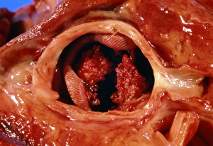 Artificial heart valve showing bacterial infection Artificial heart valve showing bacterial infection