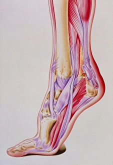 Artwork of acute inflammation of achilles tendon Artwork of acute inflammation of achilles tendon