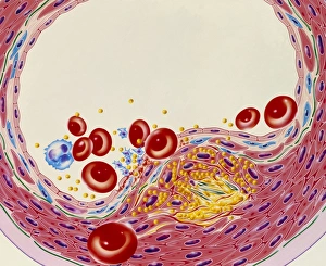 Artwork of artery narrowed by atherosclerosis Artwork of artery narrowed by atherosclerosis