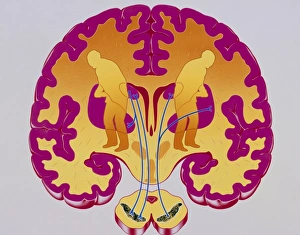 Artwork of brain depicting Parkinsons disease Artwork of brain depicting Parkinsons disease
